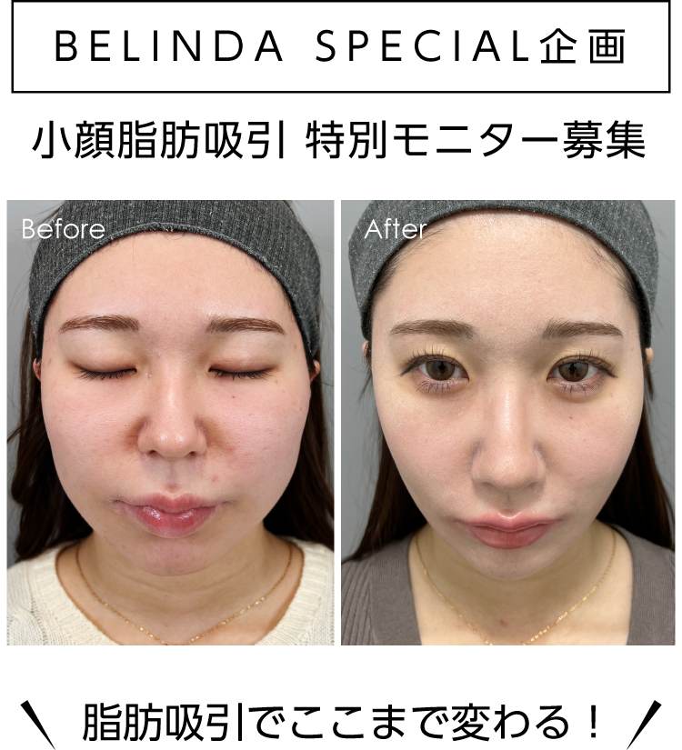 小顔脂肪吸引モニター募集