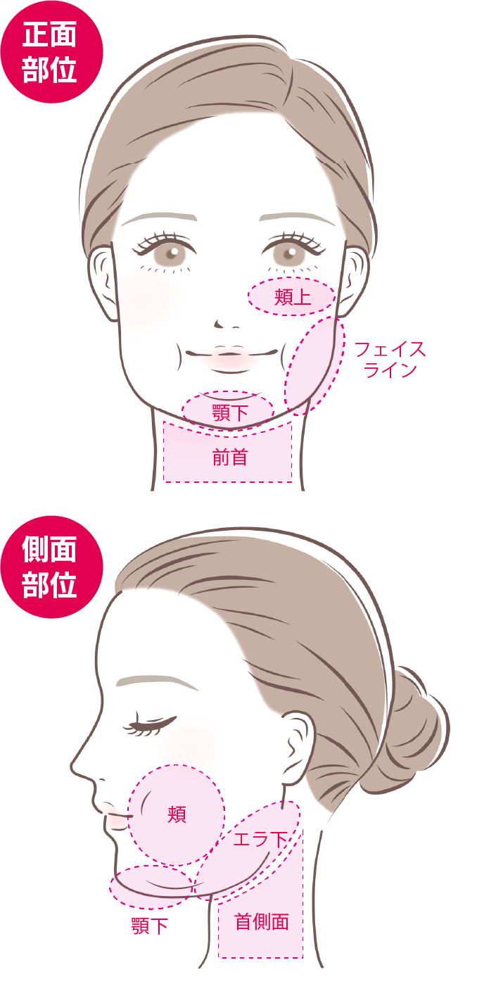 BELINDAの小顔脂肪吸引部位