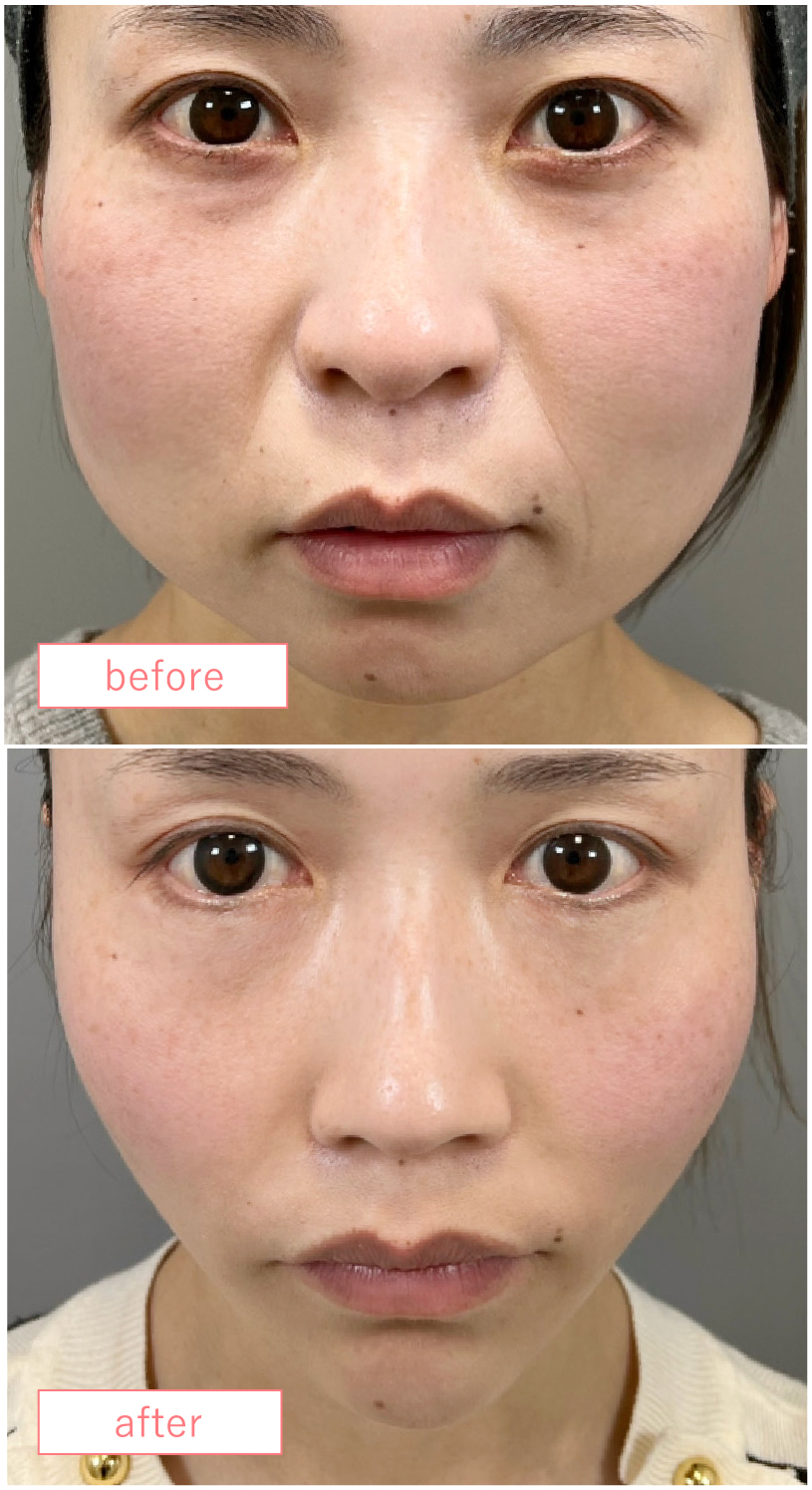 サクション糸リフト